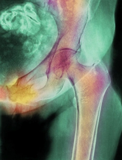 Coloured X-ray of hip fracture due to osteoporosis Coloured X-ray of hip fracture due to osteoporosis