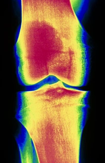Coloured X-ray image of a normal knee-joint Coloured X-ray image of a normal knee-joint