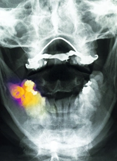 Coloured X-ray of impacted wisdom tooth and brace Coloured X-ray of impacted wisdom tooth and brace
