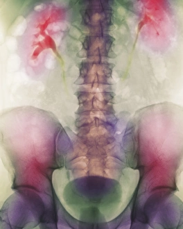 Coloured X-ray of a kidney stone in a ureter Coloured X-ray of a kidney stone in a ureter