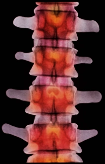 Coloured X-ray of lumbar vertebrae of the spine Coloured X-ray of lumbar vertebrae of the spine