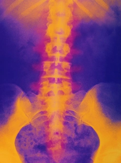 Coloured X-ray of normal lower spine and pelvis Coloured X-ray of normal lower spine and pelvis