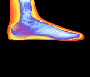 Coloured X-ray of a womans flat foot Coloured X-ray of a womans flat foot