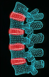 Computer artwork of the five lumbar vertebrae Computer artwork of the five lumbar vertebrae