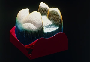 Computer graphic of a tooth ready for dental inlay Computer graphic of a tooth ready for dental inlay