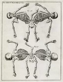 Abridged Collection: Conjoined twin skeletons, 18th century