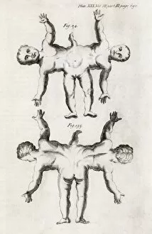 Abridged Collection: Conjoined twins, 18th century