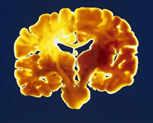 Coronal slice through a healthy human brain Coronal slice through a healthy human brain