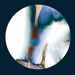 Prints of Corrected knee dislocation. Coloured X-ray of the dislocated and twisted knee of a female baby being manipulated back into place. The hand of the doctor is at bottom Images Dated 2007 February: Corrected knee dislocation, X-ray Print