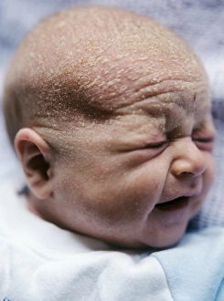 Prints of MODEL RELEASED. Cradle cap. Newborn infant suffering from cradle cap (crusta lactea). Thick yellow scales are seen in patches around the infants scalp Images Dated 2005 September: Cradle Cap Print, Newborn Infant with Seborrhoeic Dermatitis