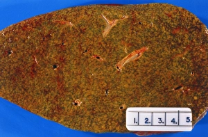 Cross-section of liver affected by cirrhosis Cross-section of liver affected by cirrhosis