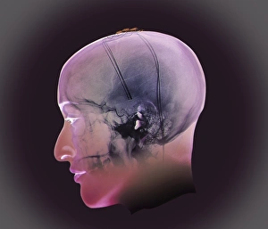 Deep Brain Stimulation Print: 3D Model of Electrode Placement