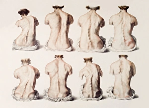19th Century Medical Illustrations Prints: Back deformities