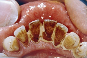 Dental plaque and tartar Dental plaque and tartar