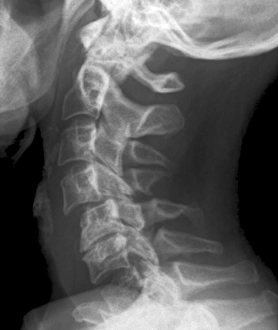 Prints of X-ray (side view) of the neck in a 57 year old patient showing dislocated vertebral bones (C5-C6) after a car accident Images Dated 2011 April: Dislocated Neck Bones Print: C5-C6 Vertebral Dislocation X-ray