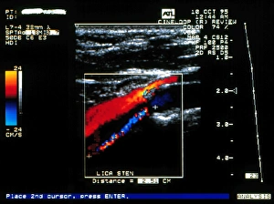 Doppler ultrasound scan of carotid artery stenosis Doppler ultrasound scan of carotid artery stenosis