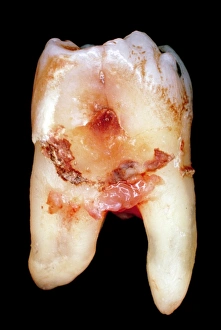 Oral Health Care Prints: Extracted molar