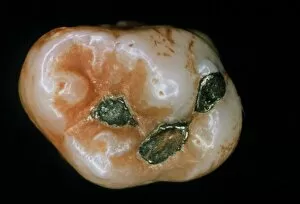Images Dated 30th July 2002: Extracted molar showing 3 amalgam fillings