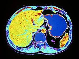 False-colour CT scan of liver & stomach False-colour CT scan of liver & stomach