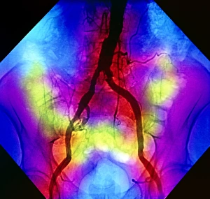 False-colour normal abdominal angiogram False-colour normal abdominal angiogram