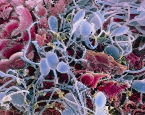False-colour SEM of sperm on a human egg False-colour SEM of sperm on a human egg