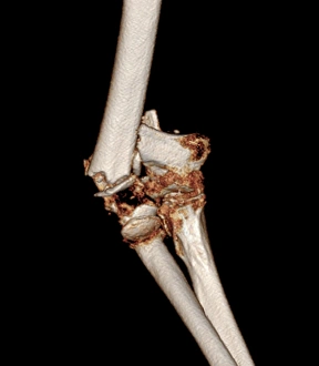 Fractured Elbow CT Scan Print