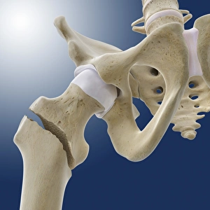 Fractured Hip Print