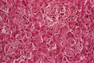 Gauchers disease Gauchers disease