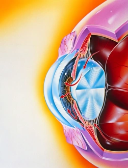 Glaucoma Glaucoma