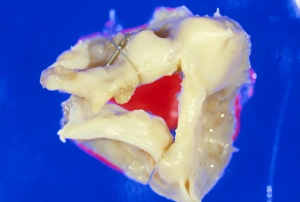 Gross specimen of stenosed aortic valve Gross specimen of stenosed aortic valve