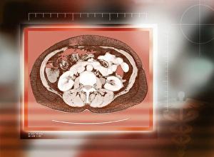 Healthy kidneys, CT scan Healthy kidneys, CT scan