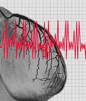 Heart attack: artwork of heart angiogram and ECG Heart attack: artwork of heart angiogram and ECG