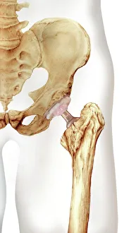 Hip Replacement Print: A Prosthetic Joint