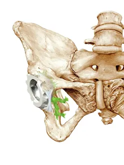Hip Replacement Print: A prosthetic hip joint socket in a pelvis