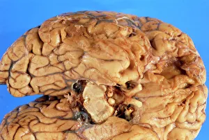Human brain showing damage due to head injury Human brain showing damage due to head injury