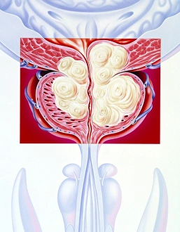 Illustration of a benign prostatic hyperplasia Illustration of a benign prostatic hyperplasia