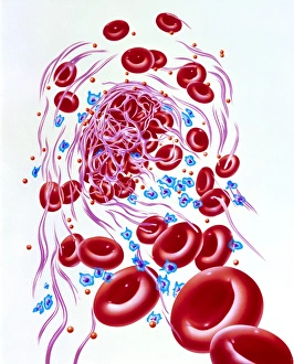 Illustration of a dissolving blood clot (thrombus) Illustration of a dissolving blood clot (thrombus)