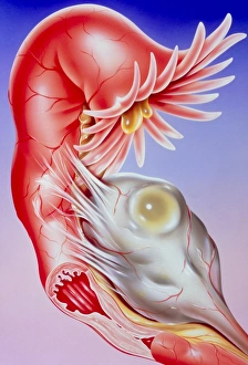 Illustration of fallopian tube infertility Illustration of fallopian tube infertility