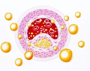 Illustration of narrowed artery in hyperlipidaemia Illustration of narrowed artery in hyperlipidaemia