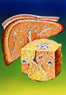 Illustration of septal cirrhosis of the liver Illustration of septal cirrhosis of the liver