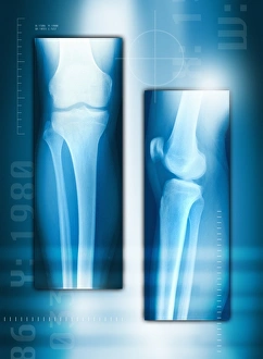 Knee joint from front and side, X-ray Knee joint from front and side, X-ray