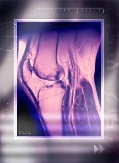 Knee joint, side view, MRI scan Knee joint, side view, MRI scan
