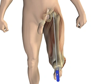 Osteoarthritis Treatment Options Prints: Knee replacement alignment, artwork