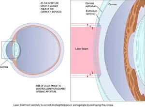Laser eye surgery, artwork Laser eye surgery, artwork