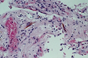 Light micrograph of asbestos fibres in lung tissue Light micrograph of asbestos fibres in lung tissue