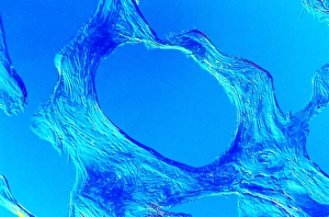 Light micrograph of compact bone with osteoporosis Light micrograph of compact bone with osteoporosis