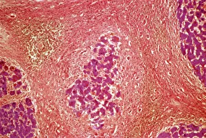 Liver tissue cirrhosis, light micrograph Liver tissue cirrhosis, light micrograph
