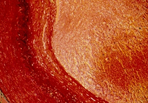 LM of cross-section of artery with atherosclerosis LM of cross-section of artery with atherosclerosis