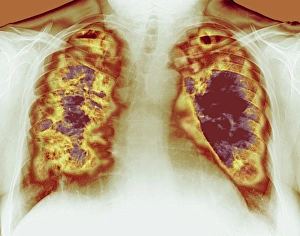 Loss of lung tissue, X-ray Loss of lung tissue, X-ray