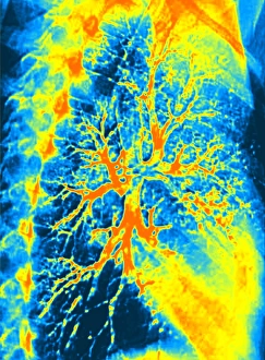 Lung bronchogram, coloured X-ray Lung bronchogram, coloured X-ray